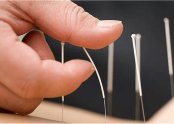 6 Important Things to Know About Acupuncture Treatments